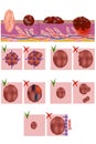 The anatomical structure of a mole and melanoma.